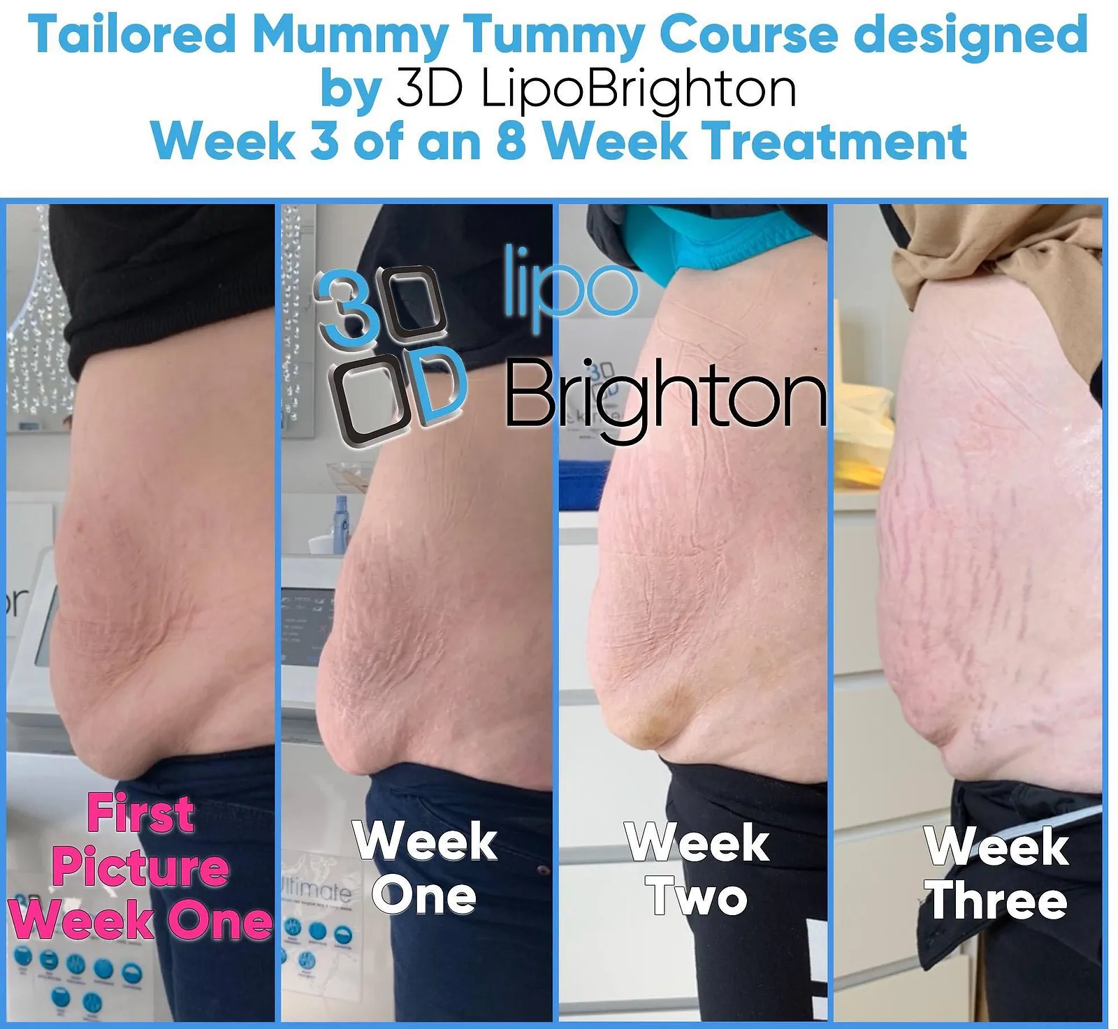 Mummy Tummy Before & After Cavitation an