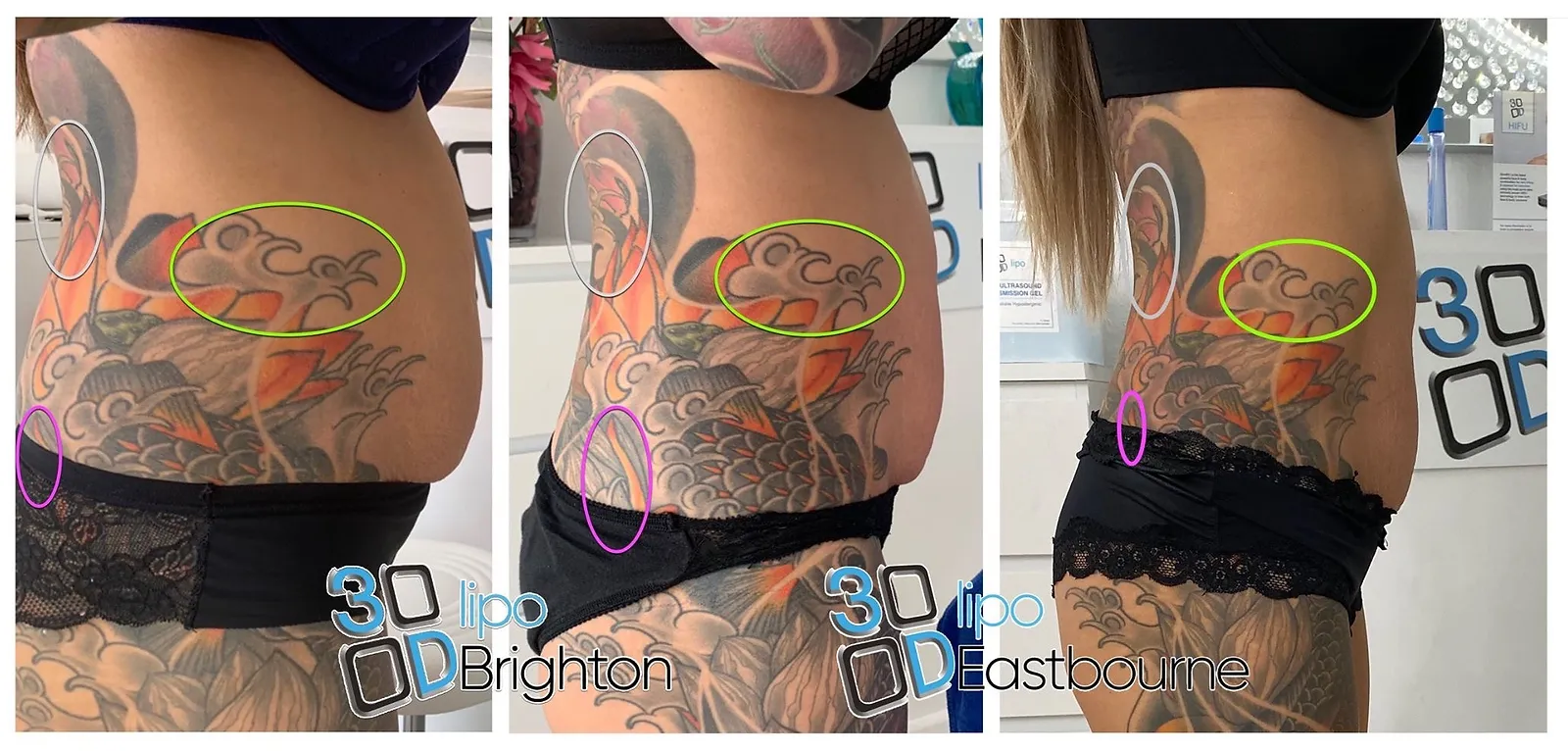 3D Lipo Eastbourne mummy tummy