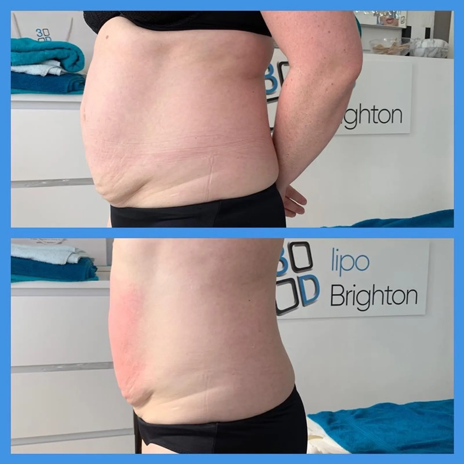 3D Lipo Eastbourne
